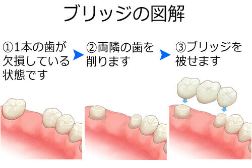 ブリッジの図解