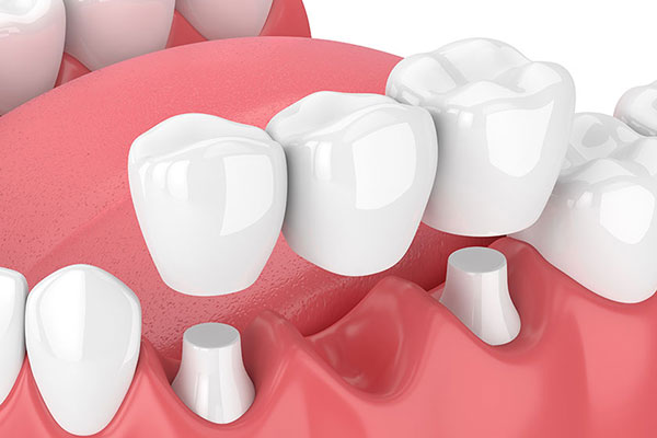 �����u���b�W�̃C���[�W