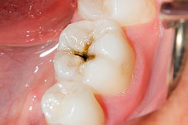 子供の永久歯の虫歯