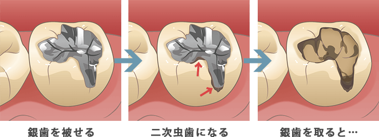 二次虫歯が出来る様子