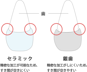 セラミックと銀歯の比較
