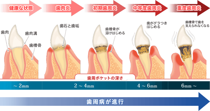 歯周病の進行