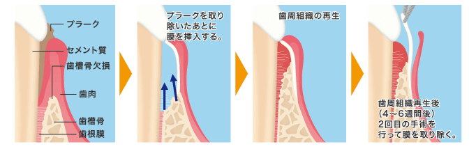 歯周組織再生治療(GTR)