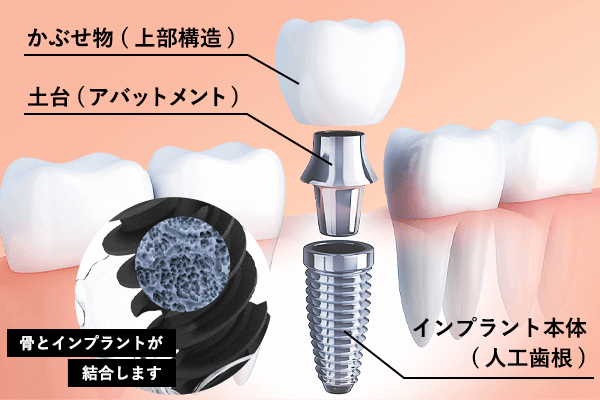 インプラントの構造