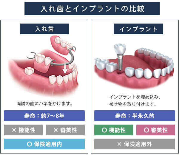 入れ歯とインプラントの比較