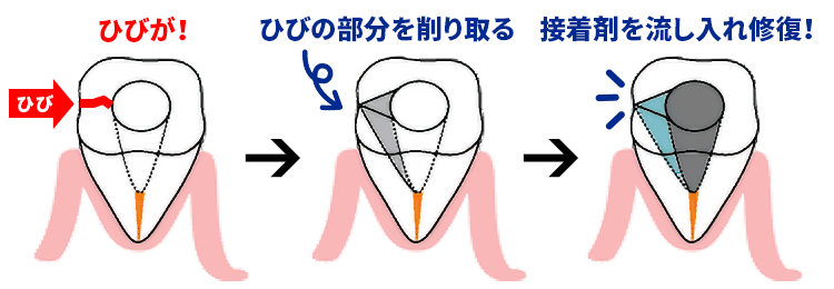 口腔内接着法