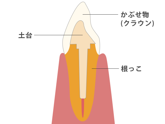 킹