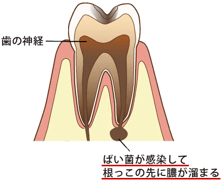 神経の無い歯は虫歯になりやすくなる