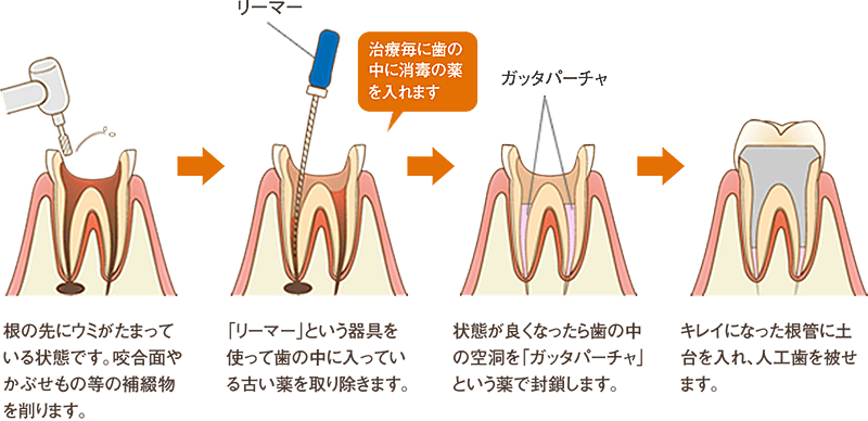 神経 を 抜い た 歯 が 痛む