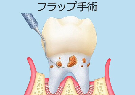 フラップ手術