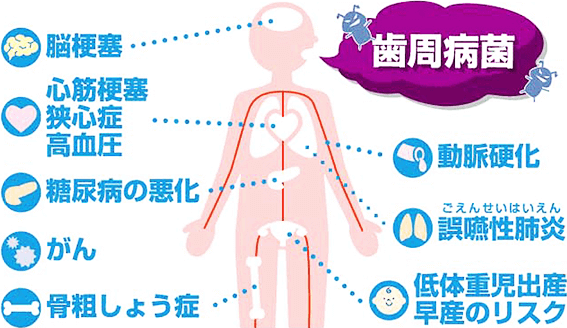 歯周病と全身疾患